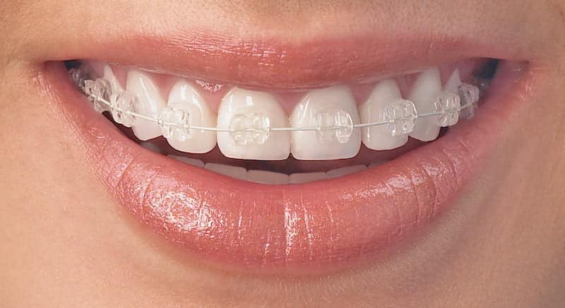 Ceramic Braces Birmingham